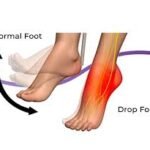 Foot drop क्या है? कारण, लक्षण और इलाज